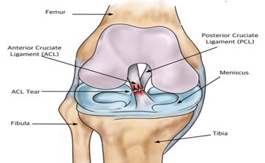 acl-injury